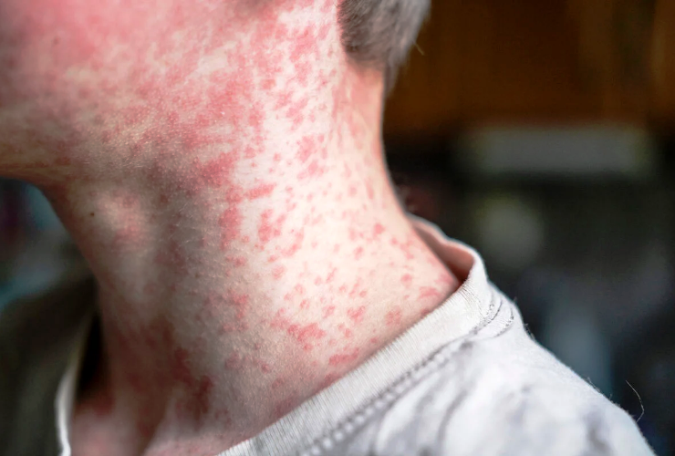 Sarampo: Crescimento de casos exige atenção da saúde pública no Brasil em 2025 23 3 9