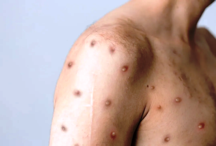 Saúde investiga novo caso suspeito de Mpox em território baiano 30 1 43